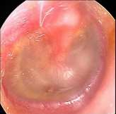 Image result for Otitis media with effusion