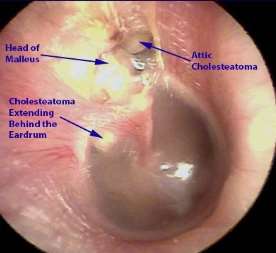 Image result for cholesteatoma