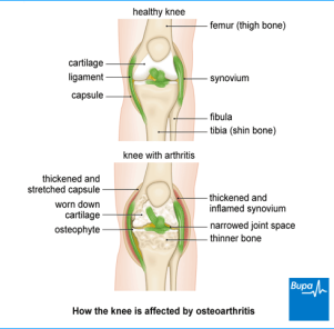 An image showing how the knee is affected by osteoarthritis