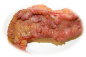 Image result for crohn's disease