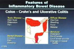 Image result for crohn's disease