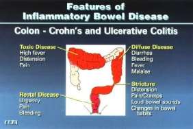 Crohn's Disease: Treatment, Causes and Symptoms