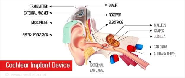 C:UsersBarshaAppDataLocalMicrosoftWindowsINetCacheContent.Wordworking-of-cochlear-implant.jpg