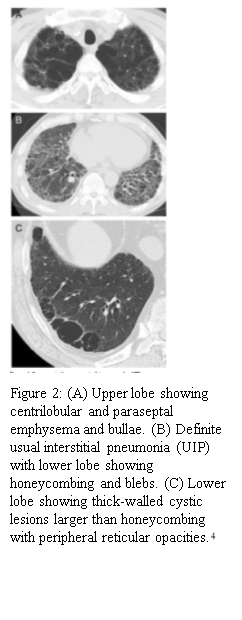 What Is Combined Pulmonary Fibrosis And Emphysema?