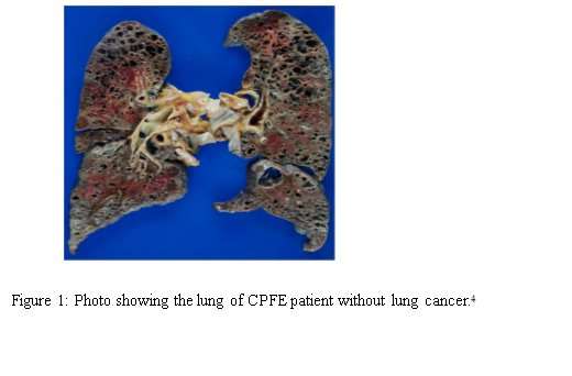 Pulmonary Fibrosis And Emphysema