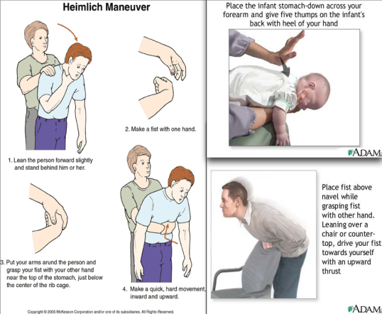 C:UsersJohnsonRupertDesktopMDS assignment picsHeimlich Maneuver for all ages.png