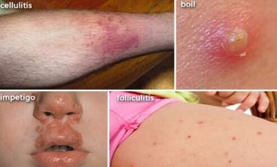 http://images.onhealth.com/images/slideshow/bacterial-infections-101-s4-skin.jpg