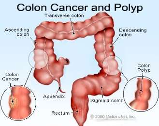 http://2.bp.blogspot.com/-9ifsN9Eeof8/UgJP3wwLWII/AAAAAAAAJuc/wZRrCey_Oko/s1600/colon_cancer.jpg