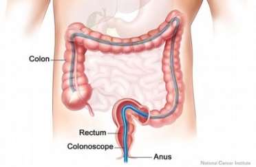 http://news.legalexaminer.com/uploadedimages/InjuryBoardcom_Content/Blogs/News_Blog/News/colonoscopy%20procedure%20color%20picture500.jpg