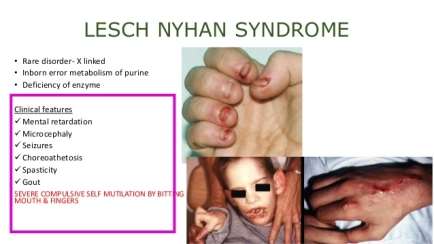 Image result for Lesch-Nyhan syndrome clinical feature