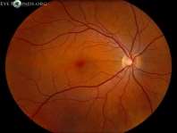 Image result for normal fundus images