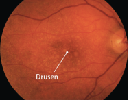 Image result for dry amd images