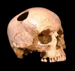 Skull with Trephination (Jmh649)